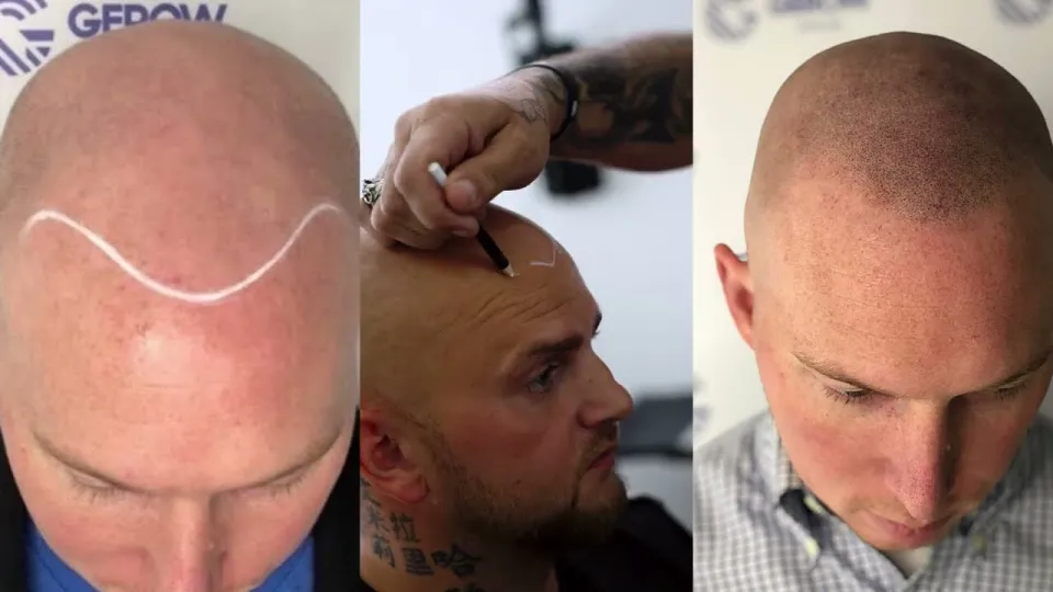 5 Best Hairloss Solutions in NYC Including Scalp Micropigmentation